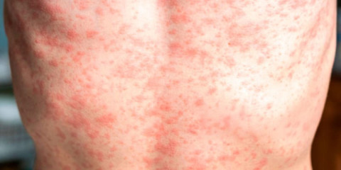 Tamaulipas libre de sarampión, pero no ha que bajar la guardia