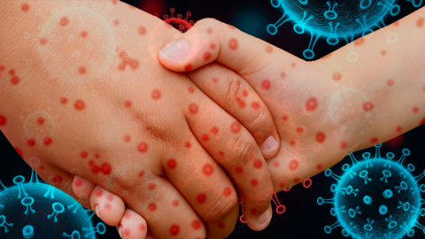 México registra casi 14 mil casos de sarampión y 35 muertes