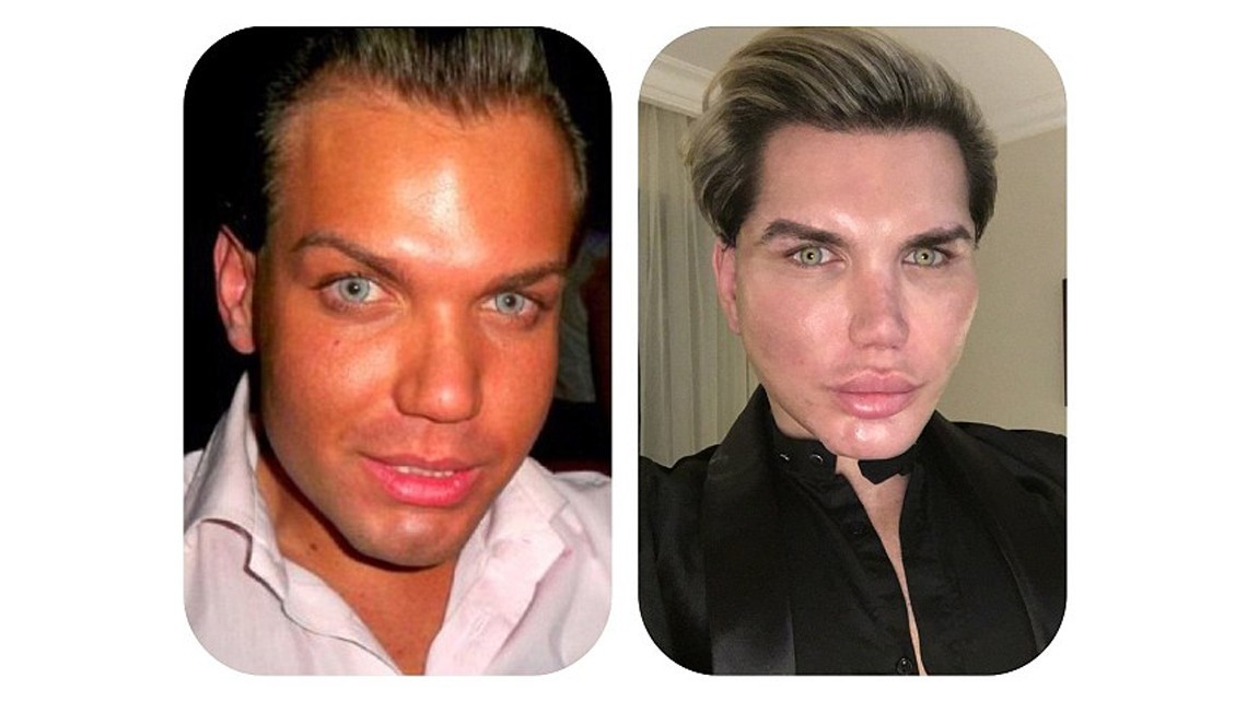 El "Ken humano" tiene complicaciones para respirar