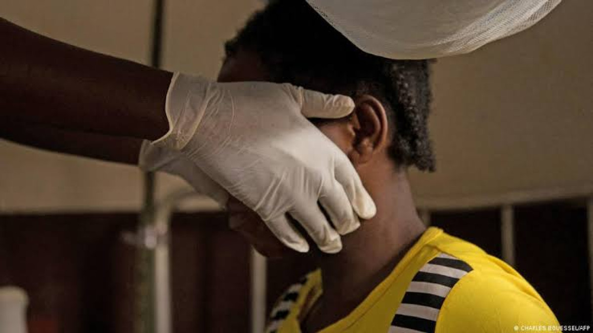 Confirman primer caso de Viruela del mono en Condado Dallas, Texas