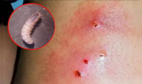 Honduras registra 27 casos de gusano barrenador en humanos y tres muertes