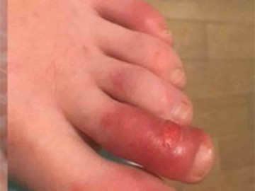 Analizan lesiones en piel como nuevo síntoma de coronavirus